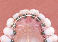 Die linguale Zahnspange